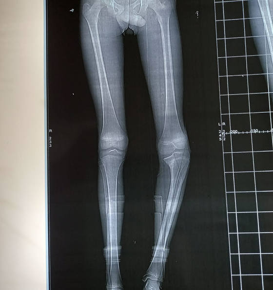 Cerebral Palsy image